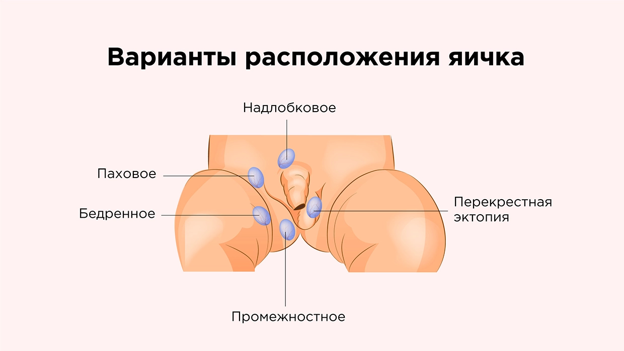 Крипторхизм у детей — лечение бесплатно по ОМС